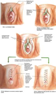 Tipos de mutilación femenina